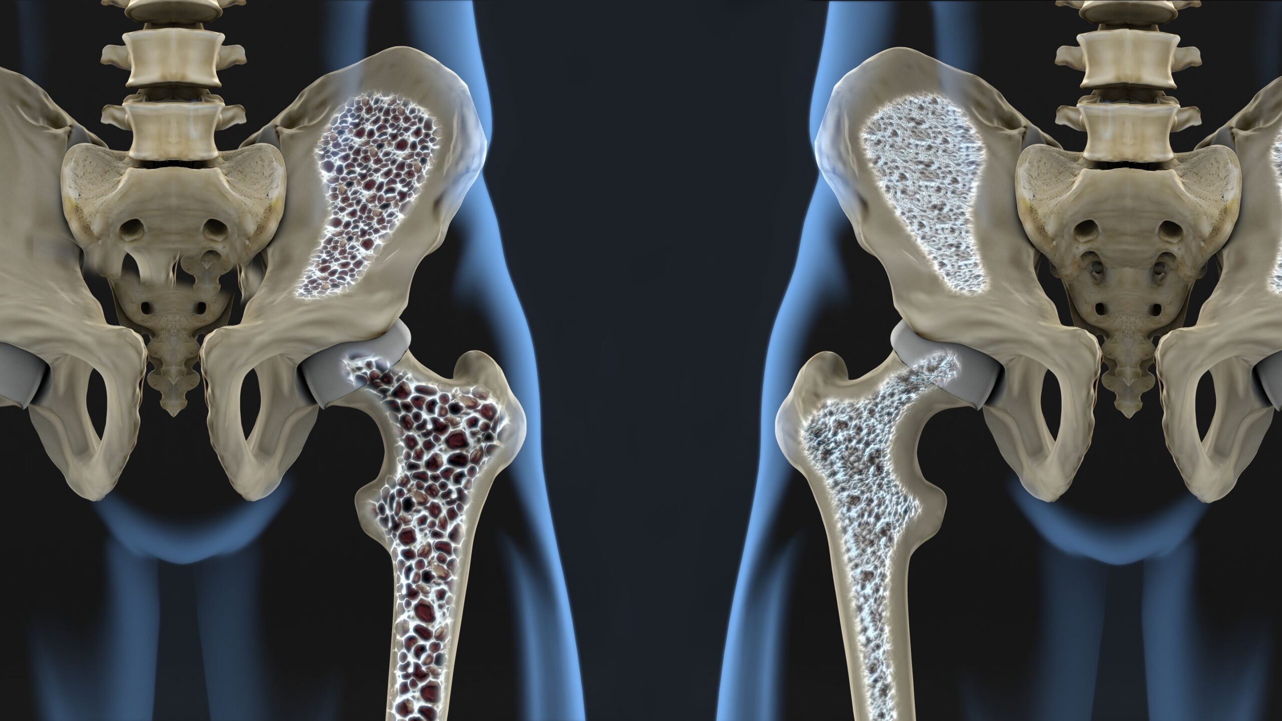 Je ziet 2 heupen, waarvan er 1 is aangetast door osteoporose.